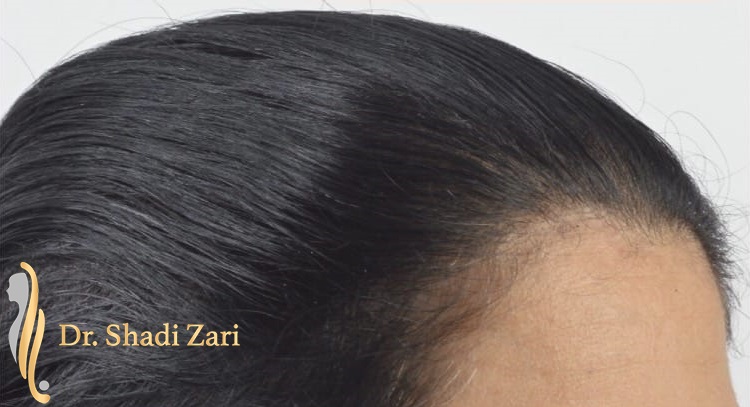 Dr. Shadi Zari | Cosmetic,and Hair Transplant Surgeon