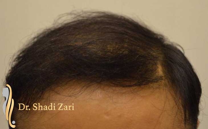 Dr. Shadi Zari | Cosmetic,and Hair Transplant Surgeon
